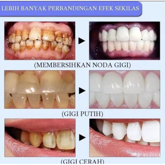 Hismile v34 Colour Corrector & Instant Teeth Whitening